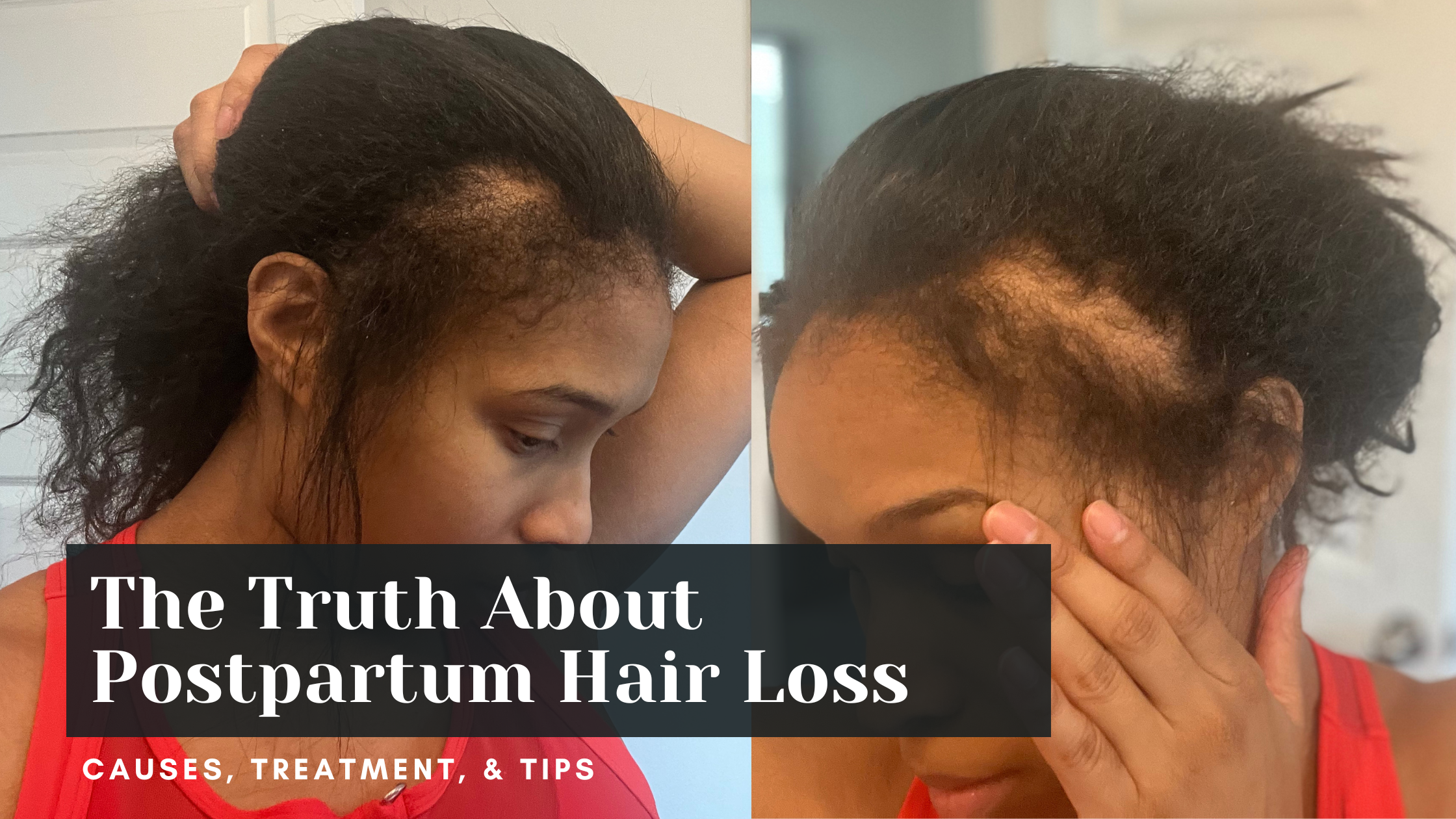 Postpartum Hair Loss: Causes, Treatment, What To Know? – Muscle Up Mommy